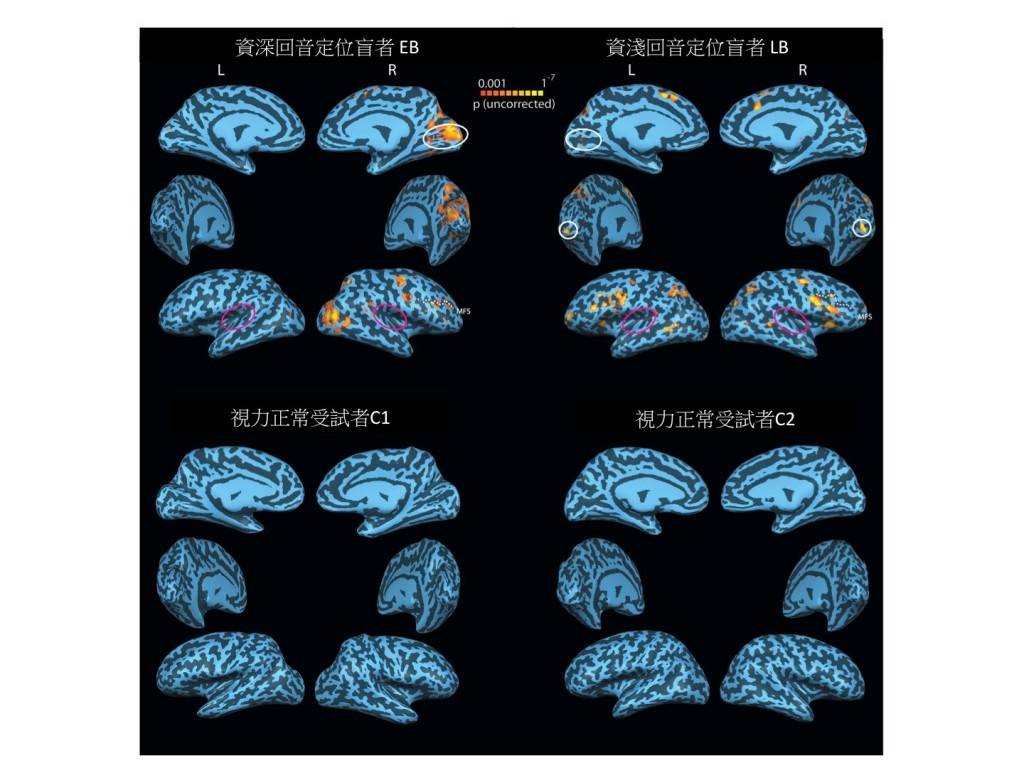 圖三：透過腦部功能性磁共振造影(fMRI)，研究員發現能夠使用回聲定位的盲人(上方)能夠在吵雜的環境中辨識出隱藏其中的回聲定位信號。此外，在接收到回聲定位信號時，盲人腦部有明顯活動的是處理視覺訊號的區塊(白色圈圈處)，而非聽覺訊號的區塊(紅色圈圈處)。 一般視力正常的受試者(下方)在同樣的測驗中則是無法分辨出任何回聲定位訊號。 (圖片來源：Thaler, et al. 2011. Neural correlates of natural human echolocation in early and late blind echolocation experts. PLoS One, 6:e20162.)