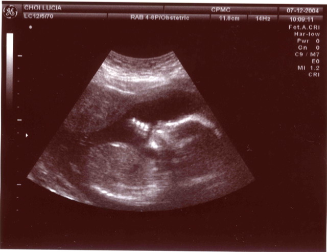 Baby_in_ultrasound