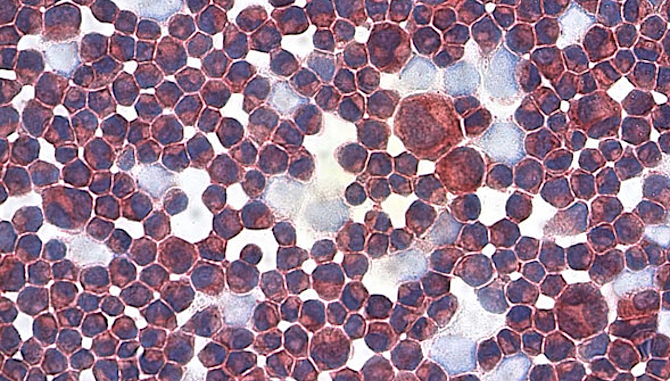 melanoma_cells