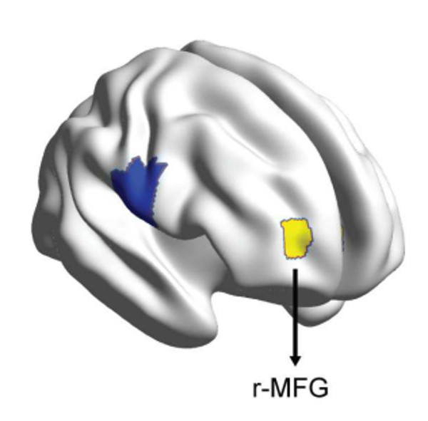 圖二：對安慰劑有反應與無反應兩者之間最大的差別在於r-MFG和其他腦部區域連結的數量。 圖片來源：Tétreault等人之論文。