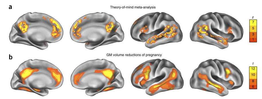 上排圖(a)是過去研究中發現與心智理論能力密切相關的區域；下排圖(b)則是灰質體積會因懷孕而改變的區域。兩者之間有很大的重疊。圖片取自參考文獻。